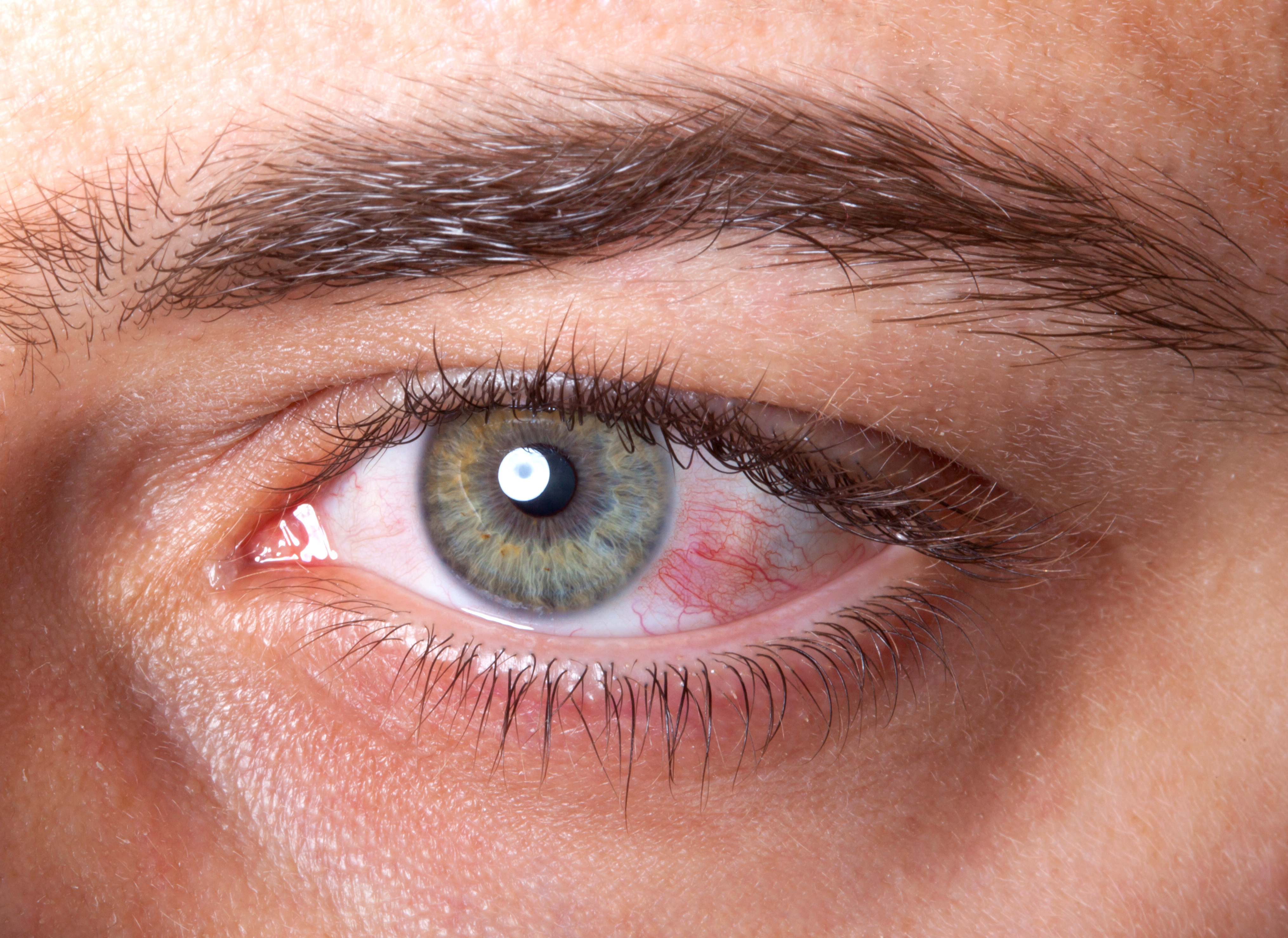 Olho seco e dor podem indicar contaminação pelo coronavírus