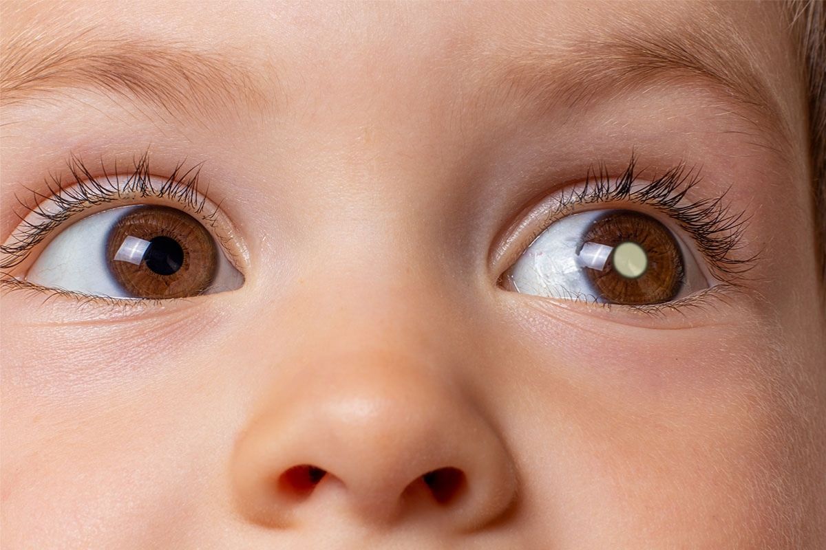 Retinoblastoma: oftalmologistas alertam população sobre cuidados com a saúde ocular das crianças