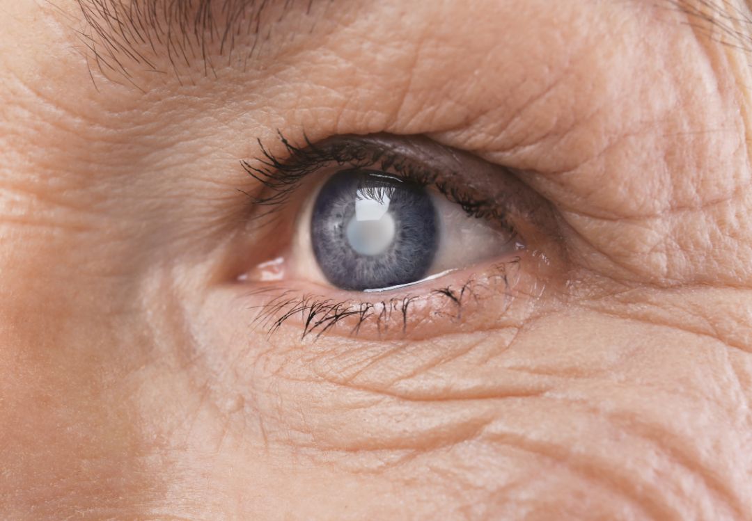 Como a cirurgia de catarata recupera a visão?